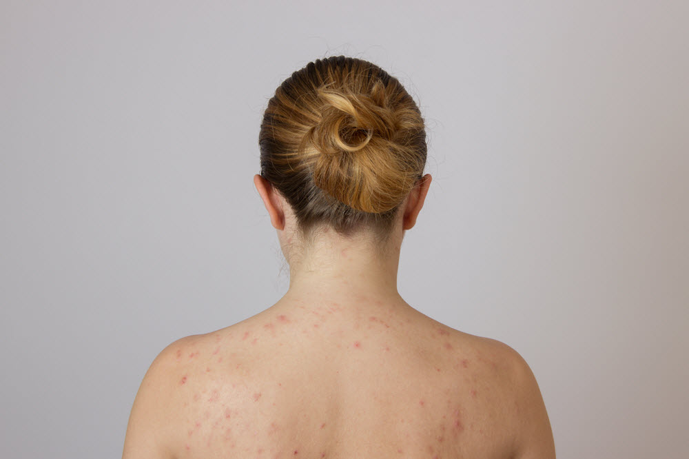 acné en la espalda